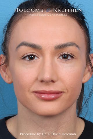 Rhinoplasty Before & After Gallery - Patient 417119 - Image 4