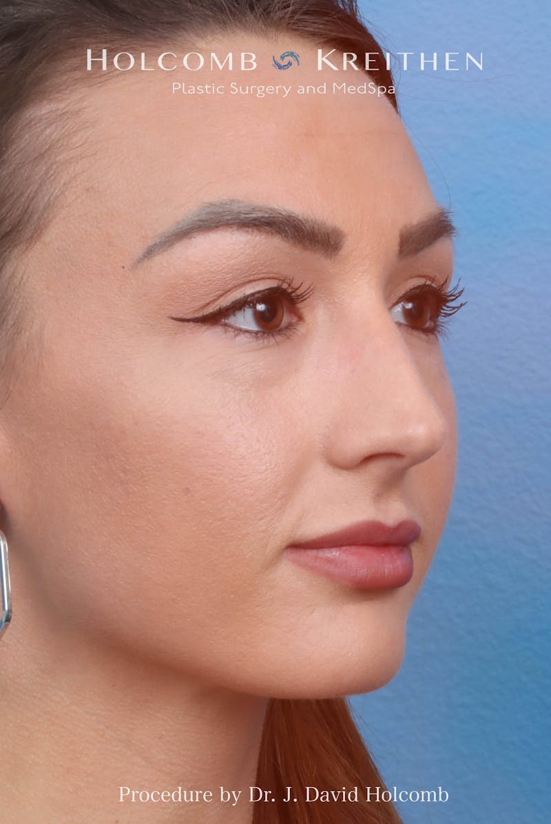 Rhinoplasty Before & After Gallery - Patient 417119 - Image 5