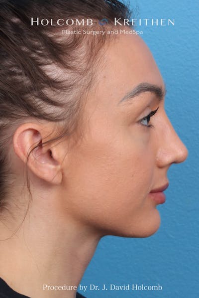 Rhinoplasty Before & After Gallery - Patient 417119 - Image 2