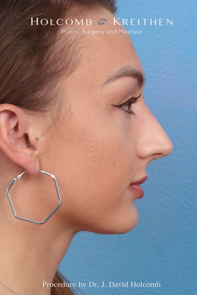 Rhinoplasty Before & After Gallery - Patient 417119 - Image 1