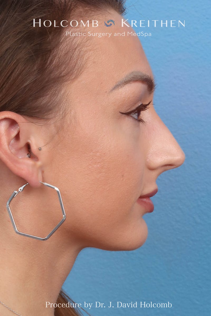 Rhinoplasty Before & After Gallery - Patient 417119 - Image 1