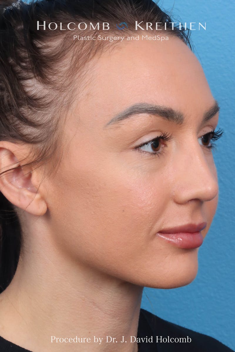 Rhinoplasty Before & After Gallery - Patient 417119 - Image 6