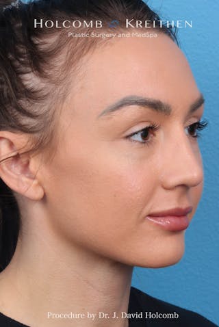 Rhinoplasty Before & After Gallery - Patient 417119 - Image 6