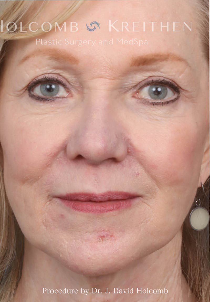 Rhinoplasty Before & After Gallery - Patient 258299 - Image 4