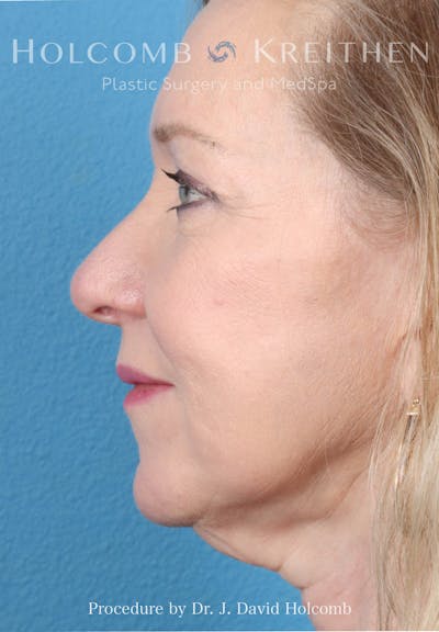 Rhinoplasty Before & After Gallery - Patient 258299 - Image 1