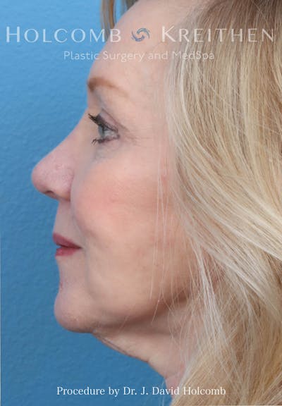Rhinoplasty Before & After Gallery - Patient 258299 - Image 2