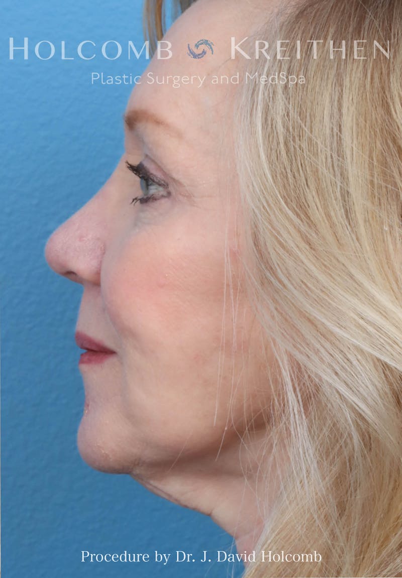 Rhinoplasty Before & After Gallery - Patient 258299 - Image 2