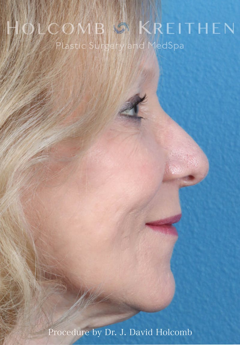 Rhinoplasty Before & After Gallery - Patient 258299 - Image 5