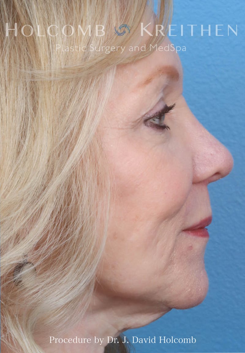 Rhinoplasty Before & After Gallery - Patient 258299 - Image 6
