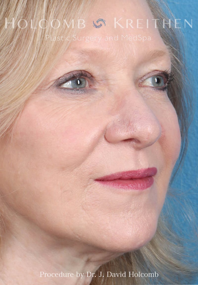 Rhinoplasty Before & After Gallery - Patient 258299 - Image 7