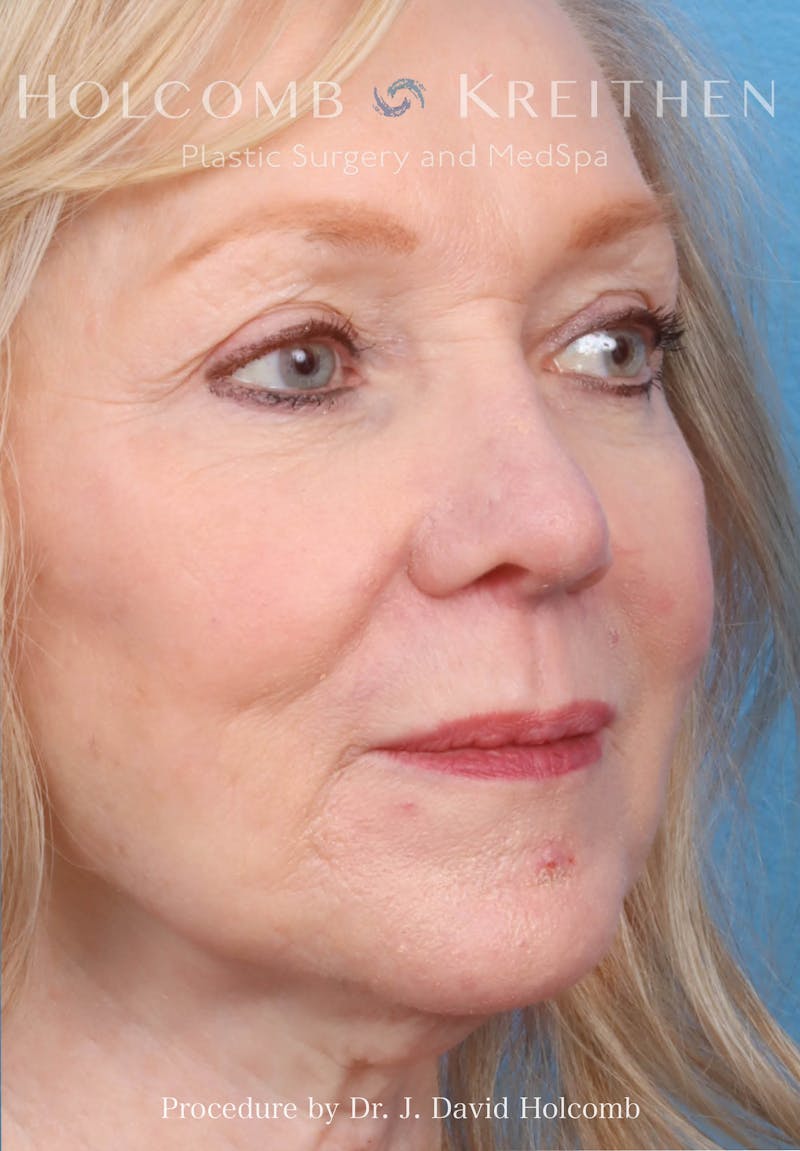 Rhinoplasty Before & After Gallery - Patient 258299 - Image 8