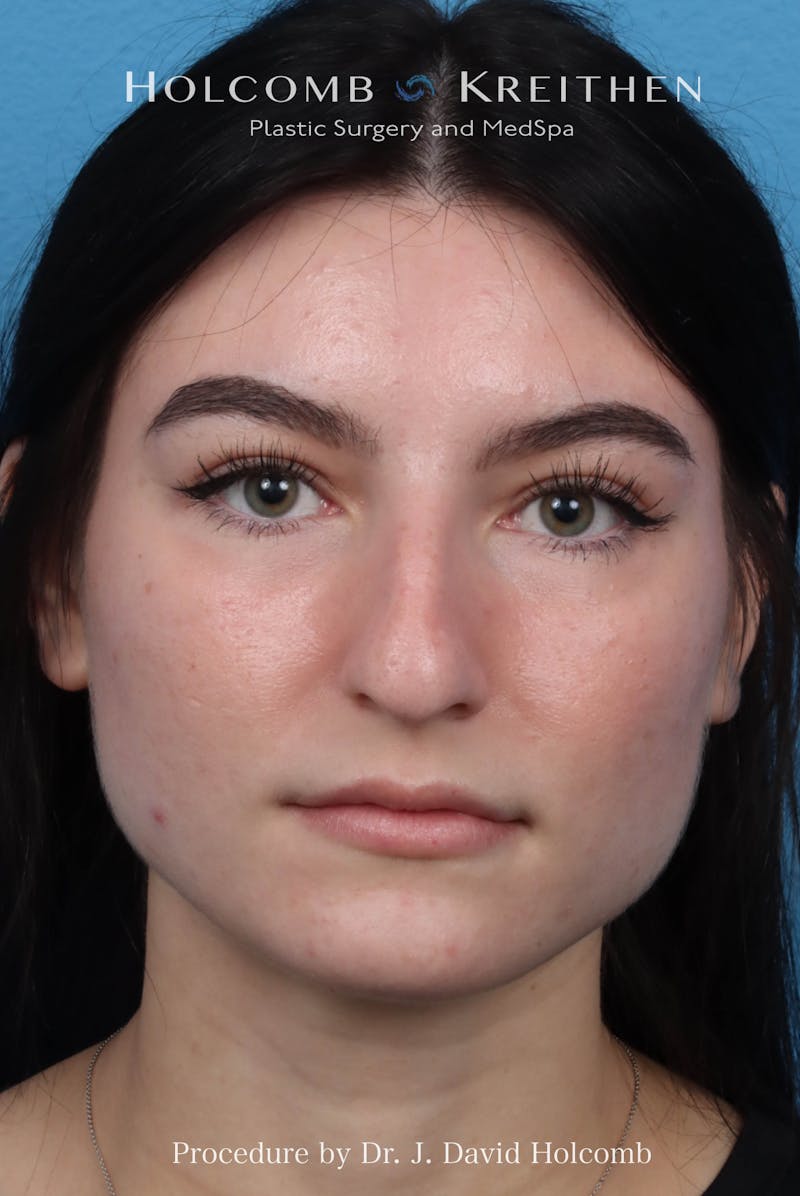 Rhinoplasty Before & After Gallery - Patient 326655 - Image 3