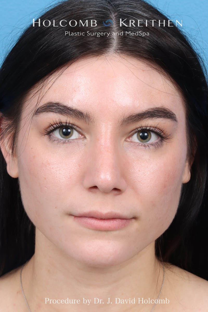 Rhinoplasty Before & After Gallery - Patient 326655 - Image 4
