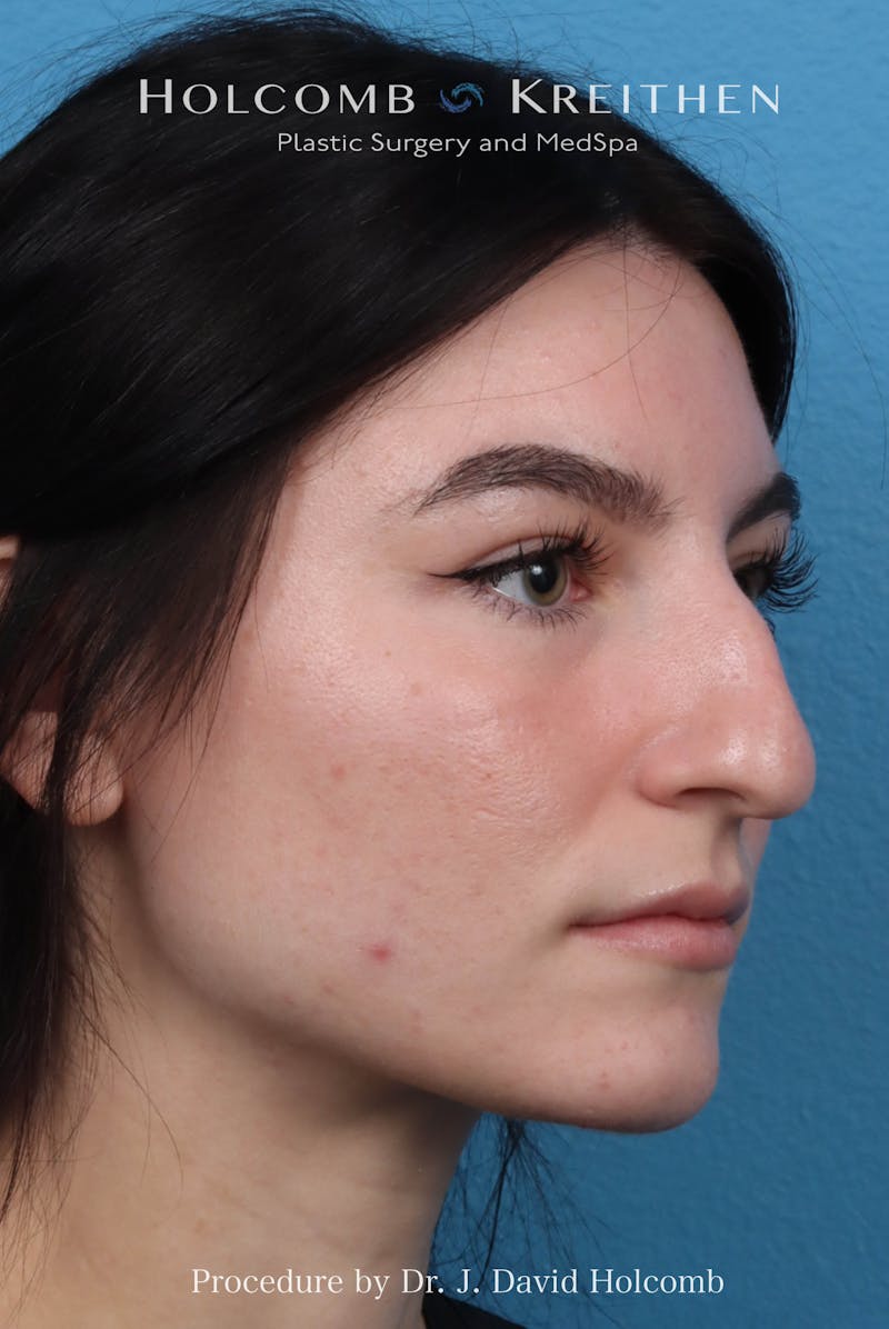 Rhinoplasty Before & After Gallery - Patient 326655 - Image 5
