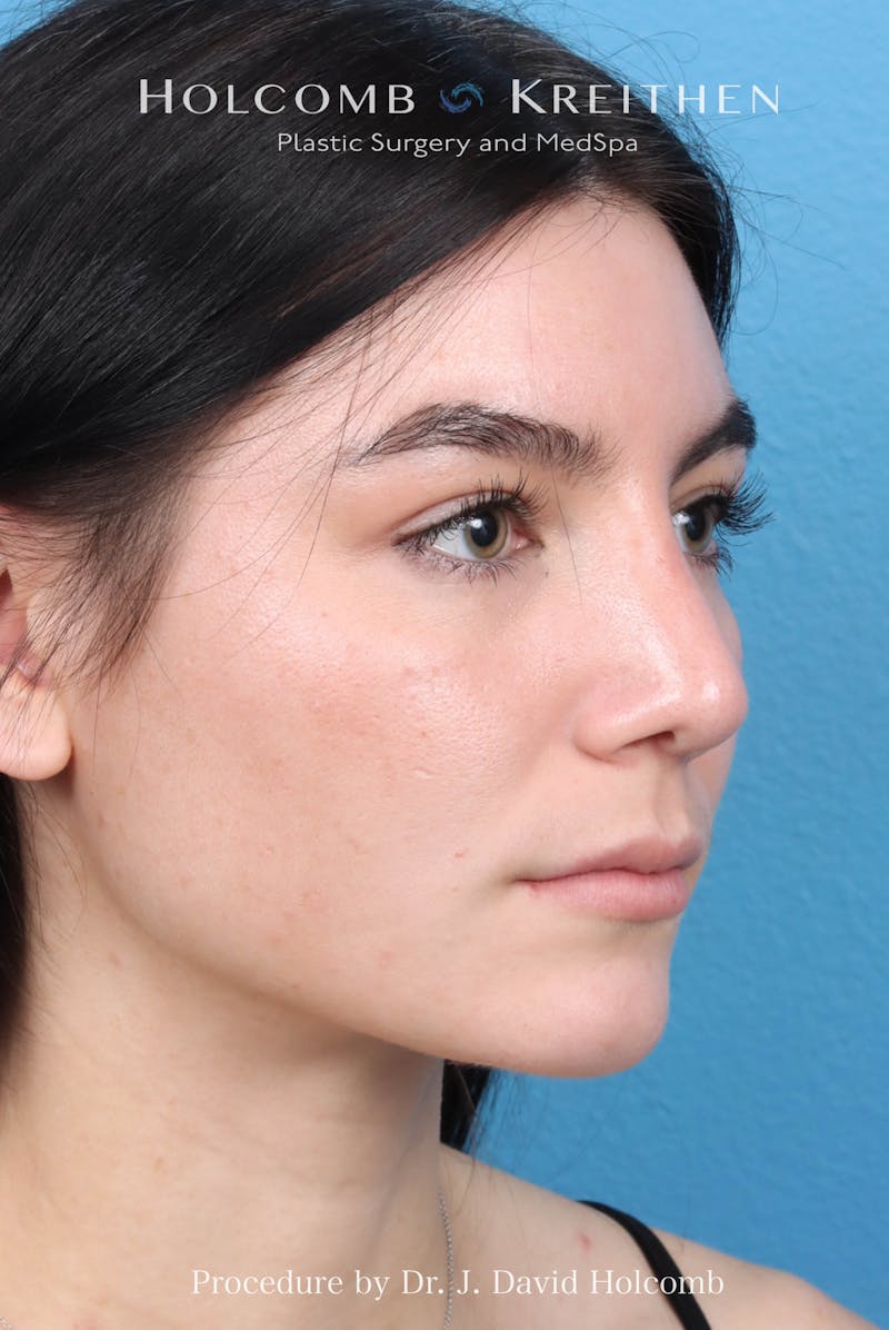 Rhinoplasty Before & After Gallery - Patient 326655 - Image 6