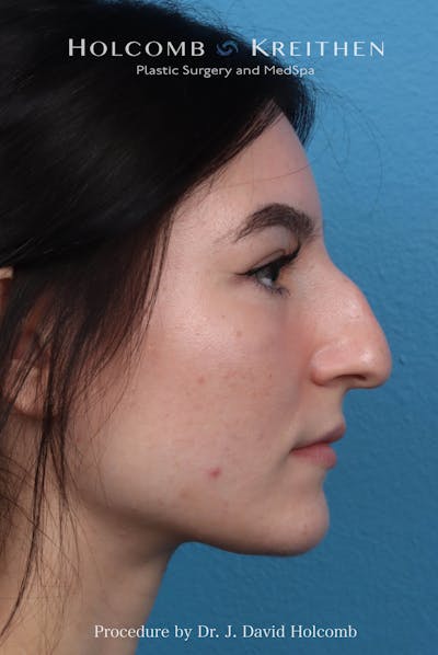 Rhinoplasty Before & After Gallery - Patient 326655 - Image 1