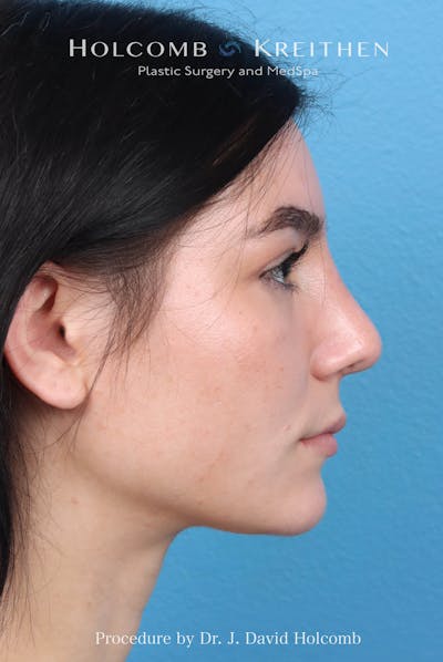 Rhinoplasty Before & After Gallery - Patient 326655 - Image 2