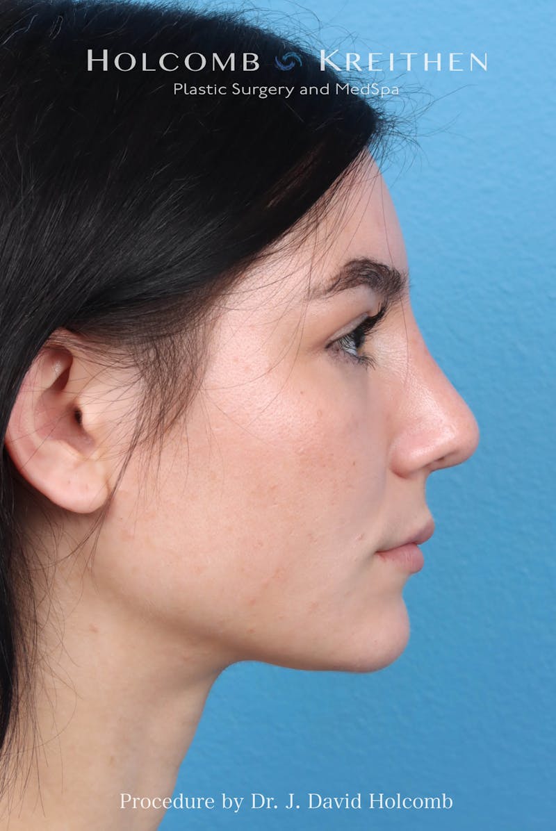 Rhinoplasty Before & After Gallery - Patient 326655 - Image 2