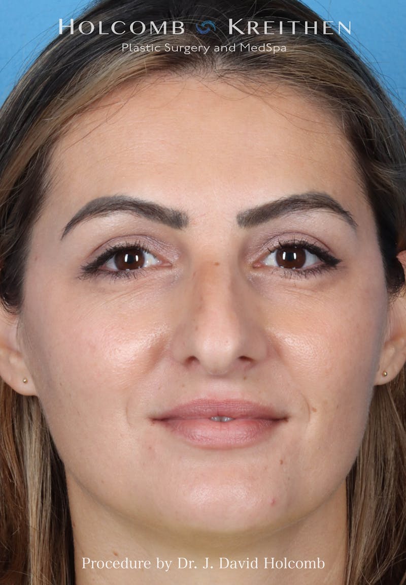 Rhinoplasty Before & After Gallery - Patient 185148 - Image 3