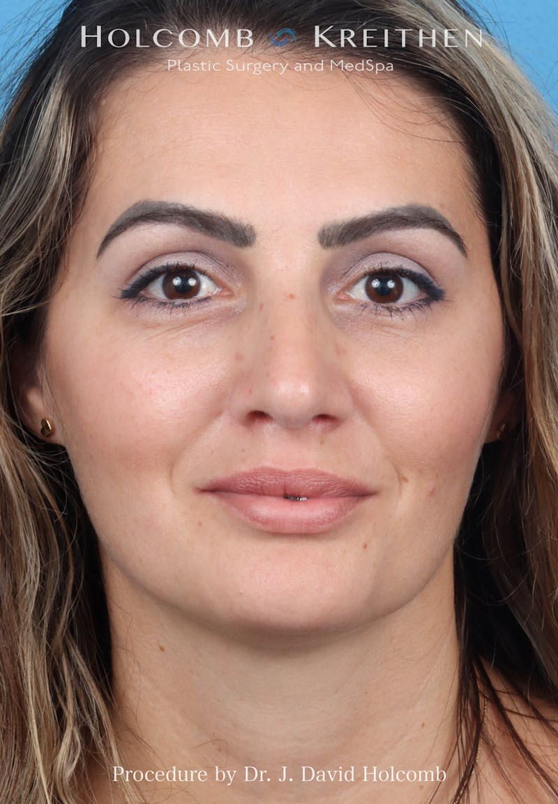 Rhinoplasty Before & After Gallery - Patient 185148 - Image 4