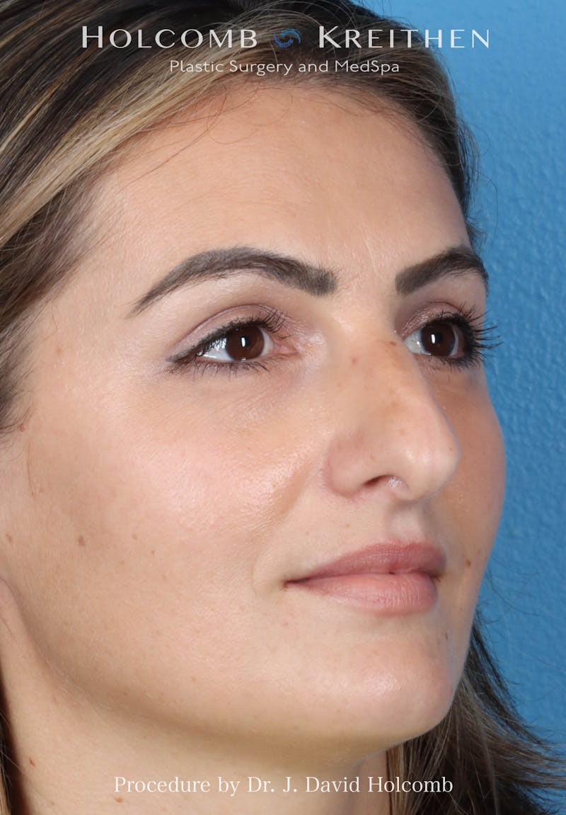 Rhinoplasty Before & After Gallery - Patient 185148 - Image 5