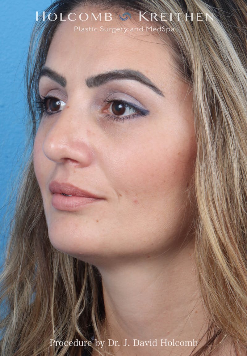 Rhinoplasty Before & After Gallery - Patient 185148 - Image 8