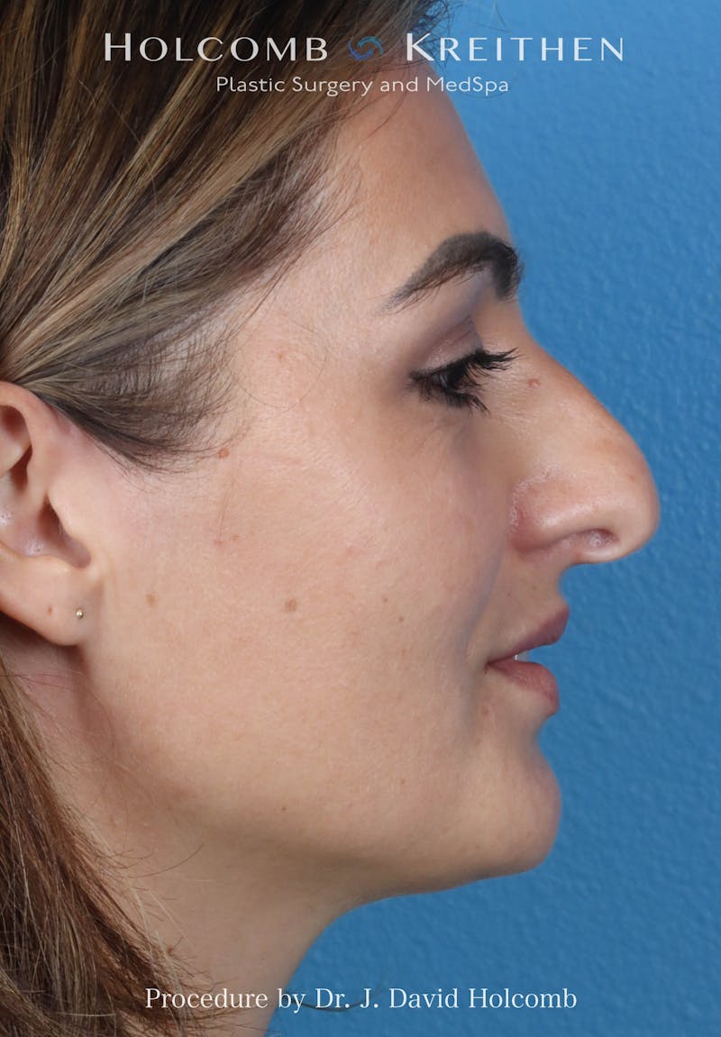 Rhinoplasty Before & After Gallery - Patient 185148 - Image 9