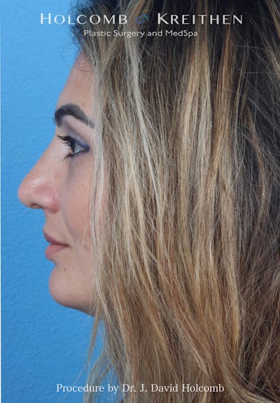 Rhinoplasty Before & After Gallery - Patient 185148 - Image 2