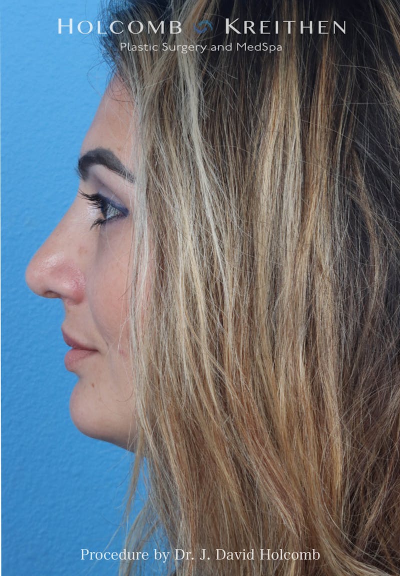 Rhinoplasty Before & After Gallery - Patient 185148 - Image 2