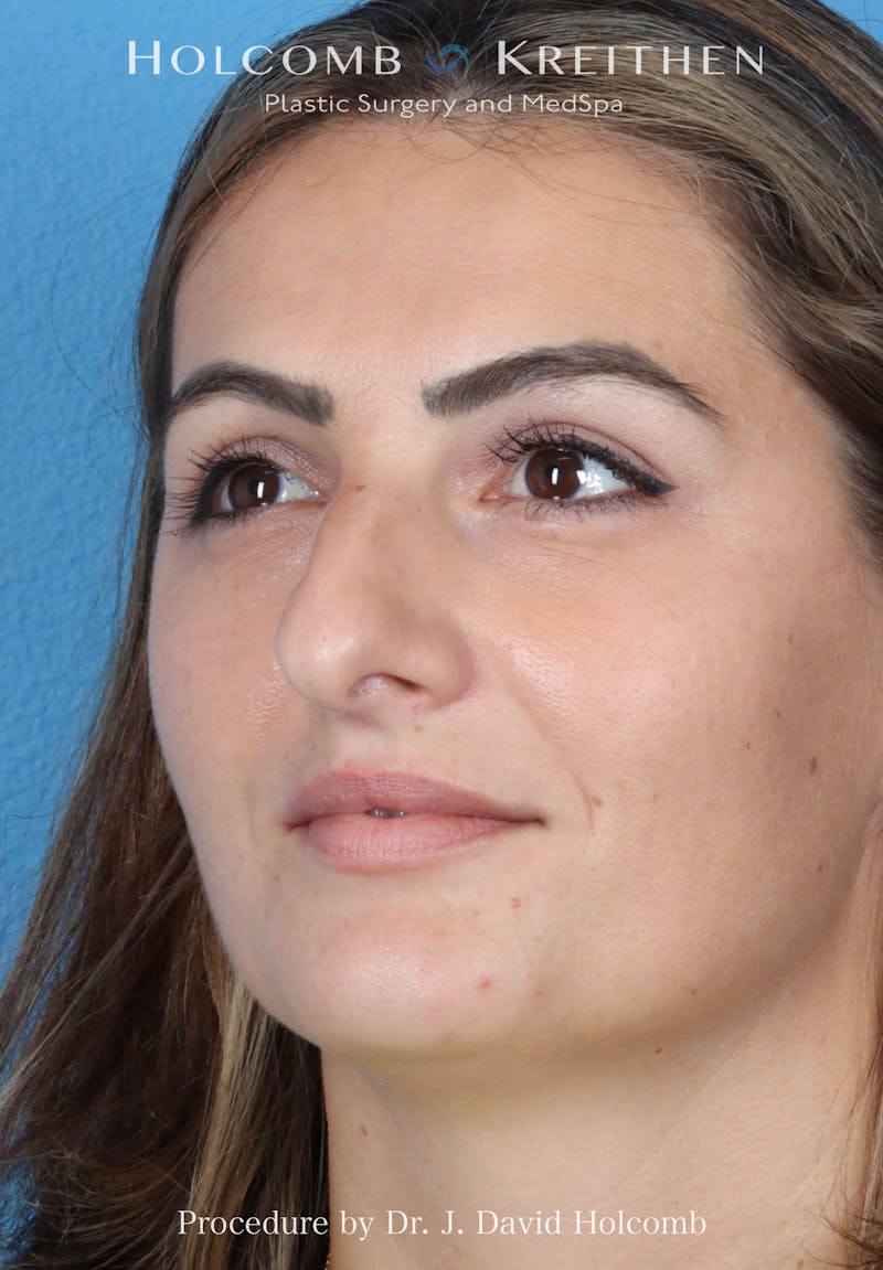 Rhinoplasty Before & After Gallery - Patient 185148 - Image 7