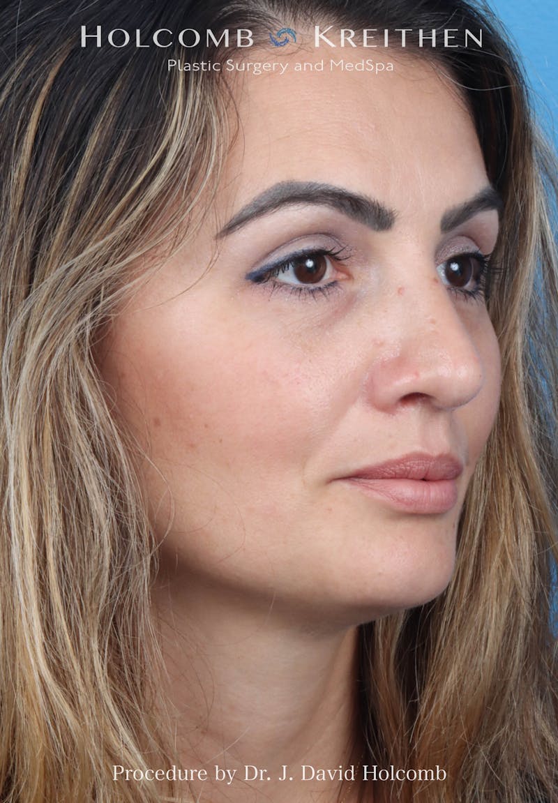 Rhinoplasty Before & After Gallery - Patient 185148 - Image 6
