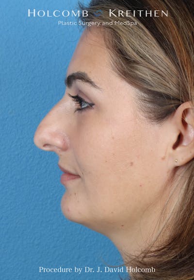 Rhinoplasty Before & After Gallery - Patient 185148 - Image 1