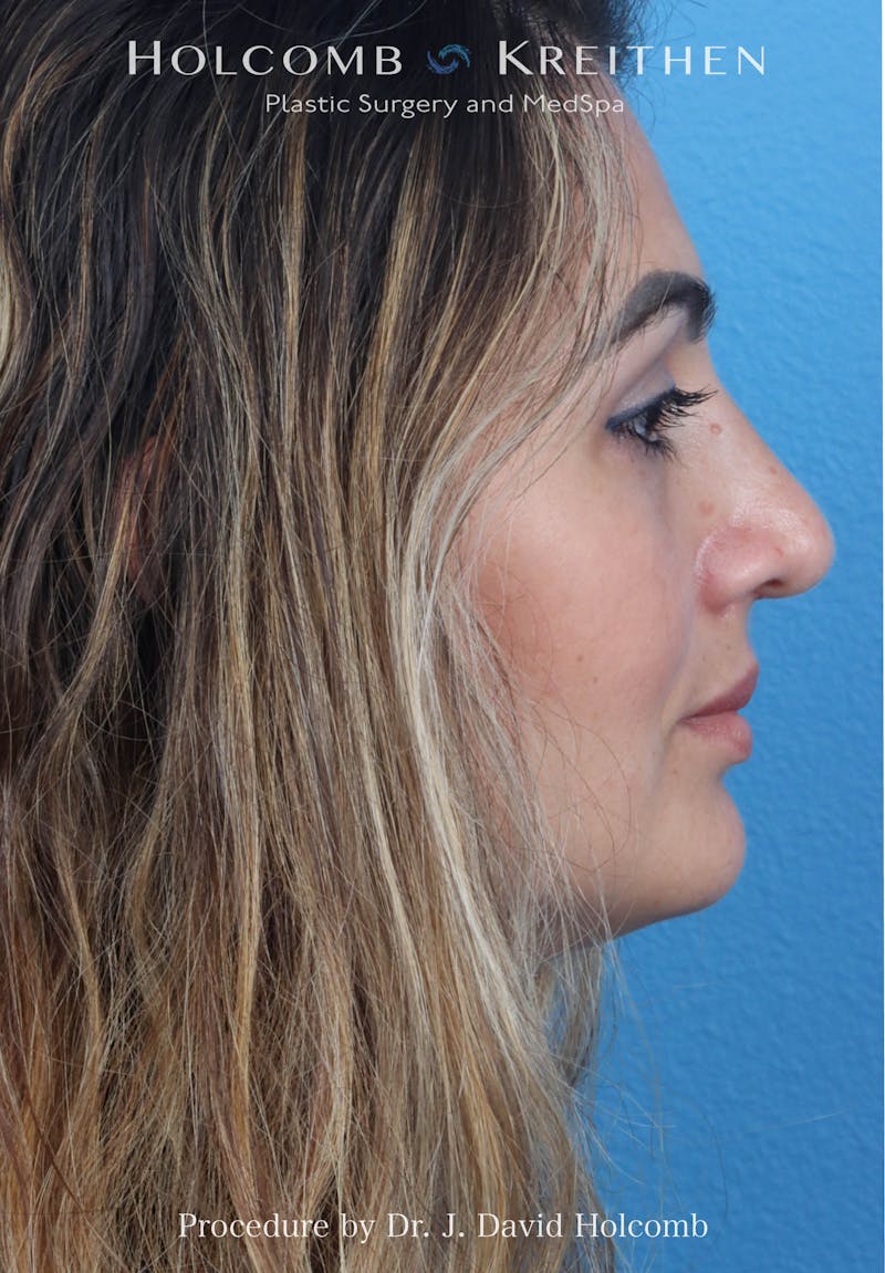 Rhinoplasty Before & After Gallery - Patient 185148 - Image 10
