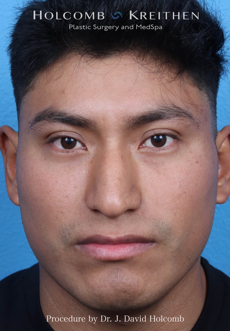 Rhinoplasty Before & After Gallery - Patient 312310 - Image 3