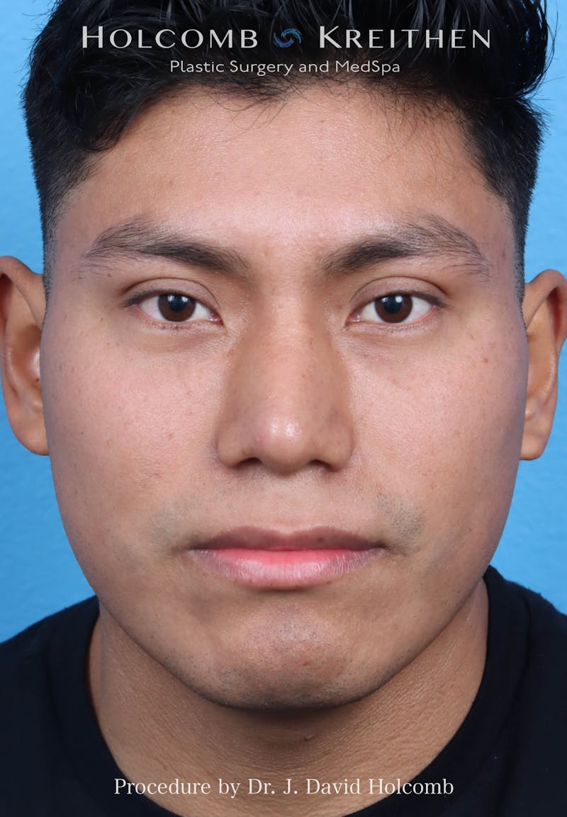 Rhinoplasty Before & After Gallery - Patient 312310 - Image 4
