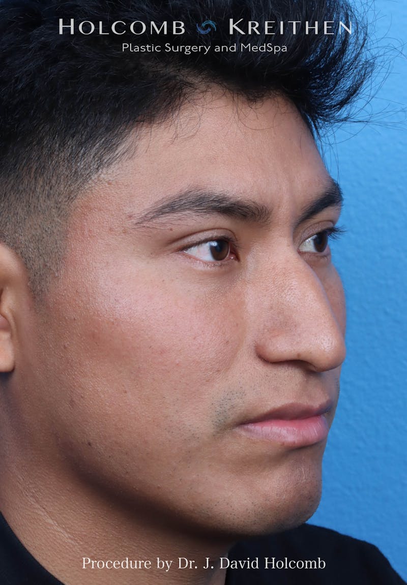 Rhinoplasty Before & After Gallery - Patient 312310 - Image 5
