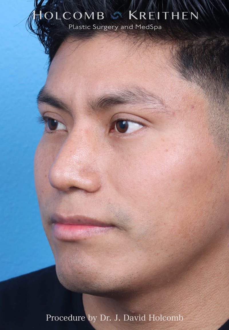Rhinoplasty Before & After Gallery - Patient 312310 - Image 8