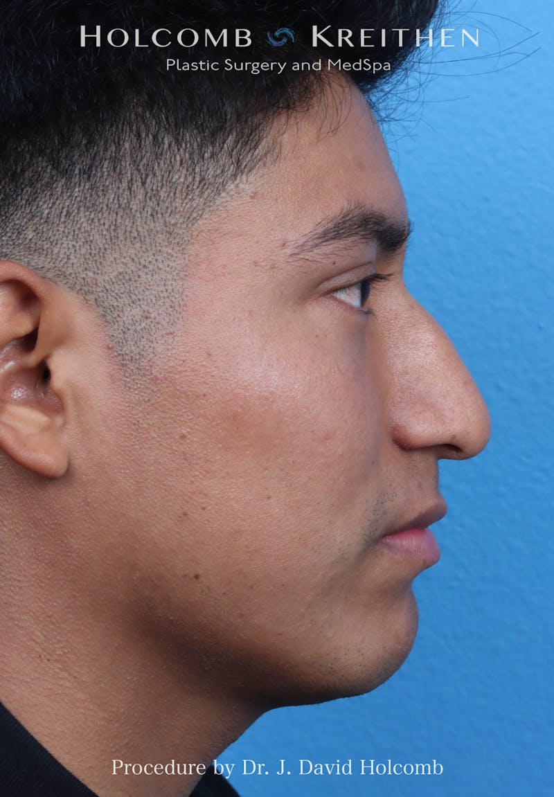 Rhinoplasty Before & After Gallery - Patient 312310 - Image 9