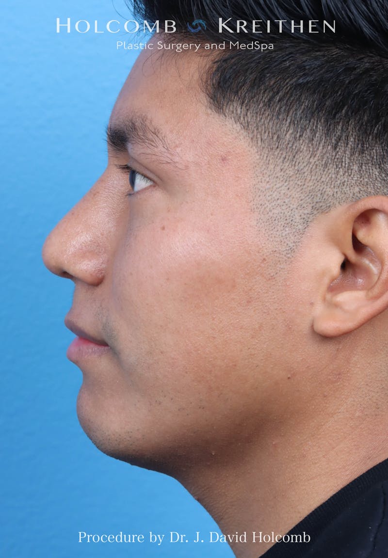 Rhinoplasty Before & After Gallery - Patient 312310 - Image 2