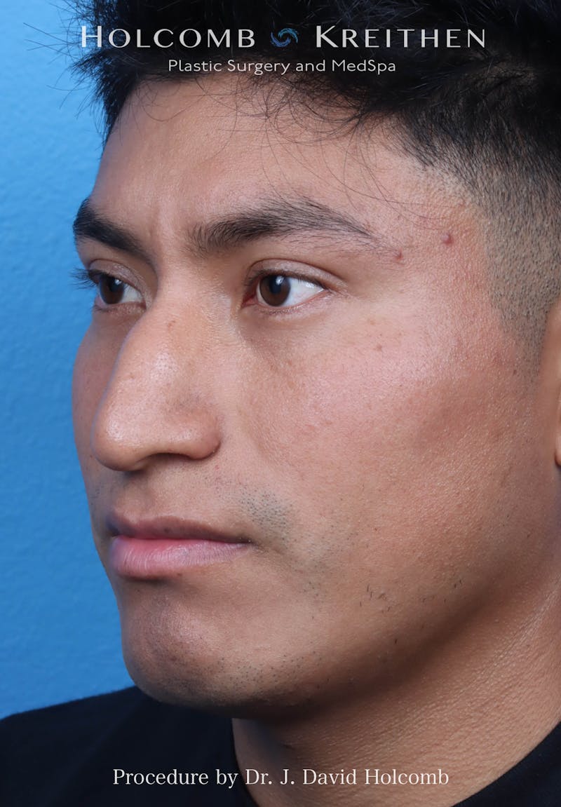 Rhinoplasty Before & After Gallery - Patient 312310 - Image 7
