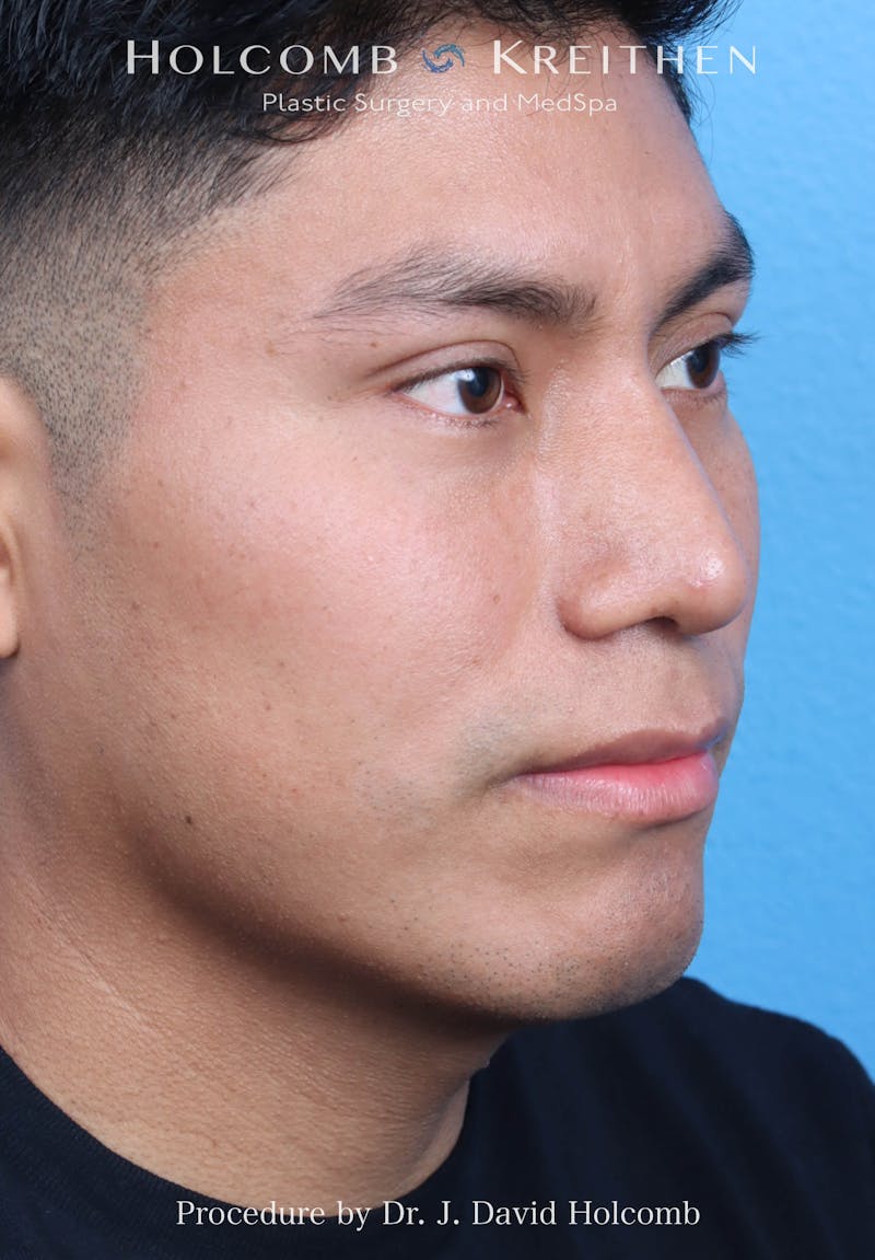 Rhinoplasty Before & After Gallery - Patient 312310 - Image 6