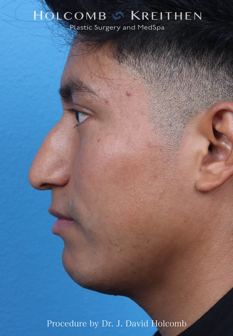Rhinoplasty Before & After Gallery - Patient 312310 - Image 1