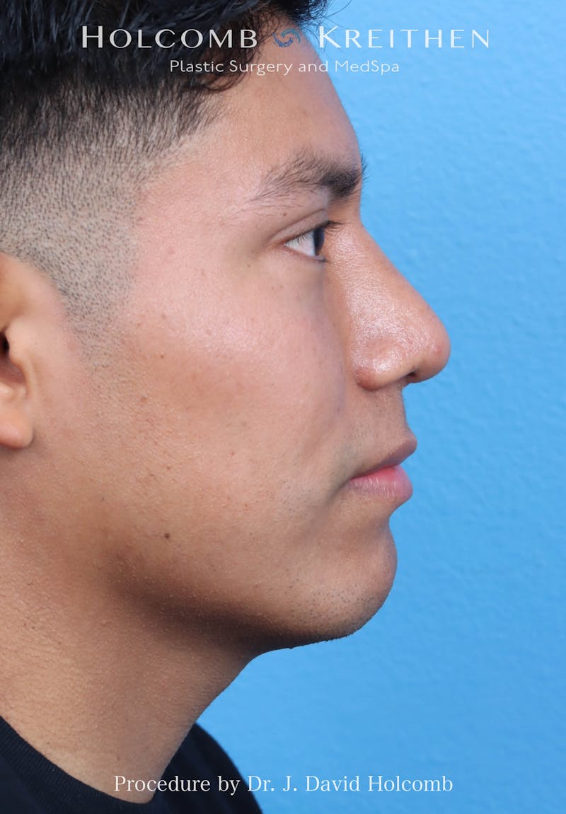 Rhinoplasty Before & After Gallery - Patient 312310 - Image 10
