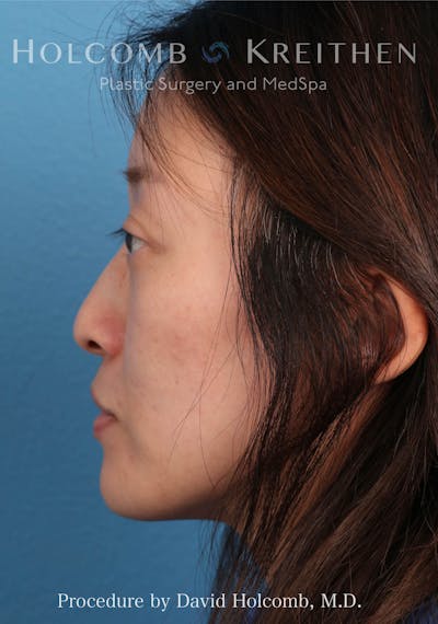 Rhinoplasty Before & After Gallery - Patient 217057 - Image 1