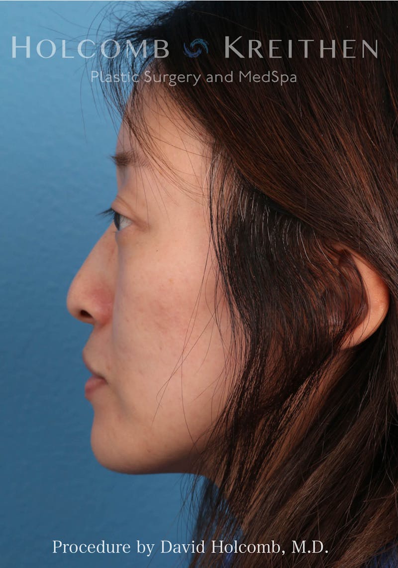Rhinoplasty Before & After Gallery - Patient 217057 - Image 1