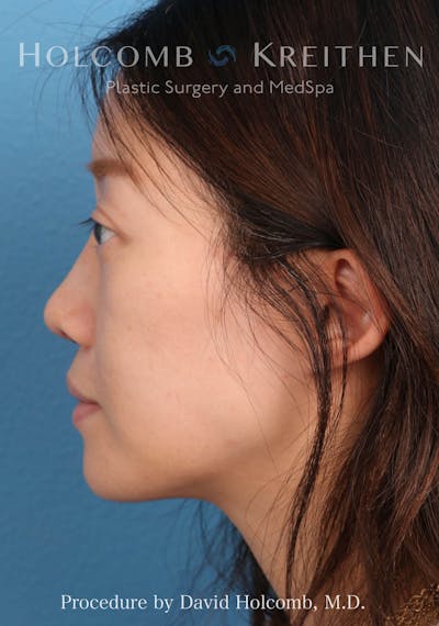 Rhinoplasty Before & After Gallery - Patient 217057 - Image 2