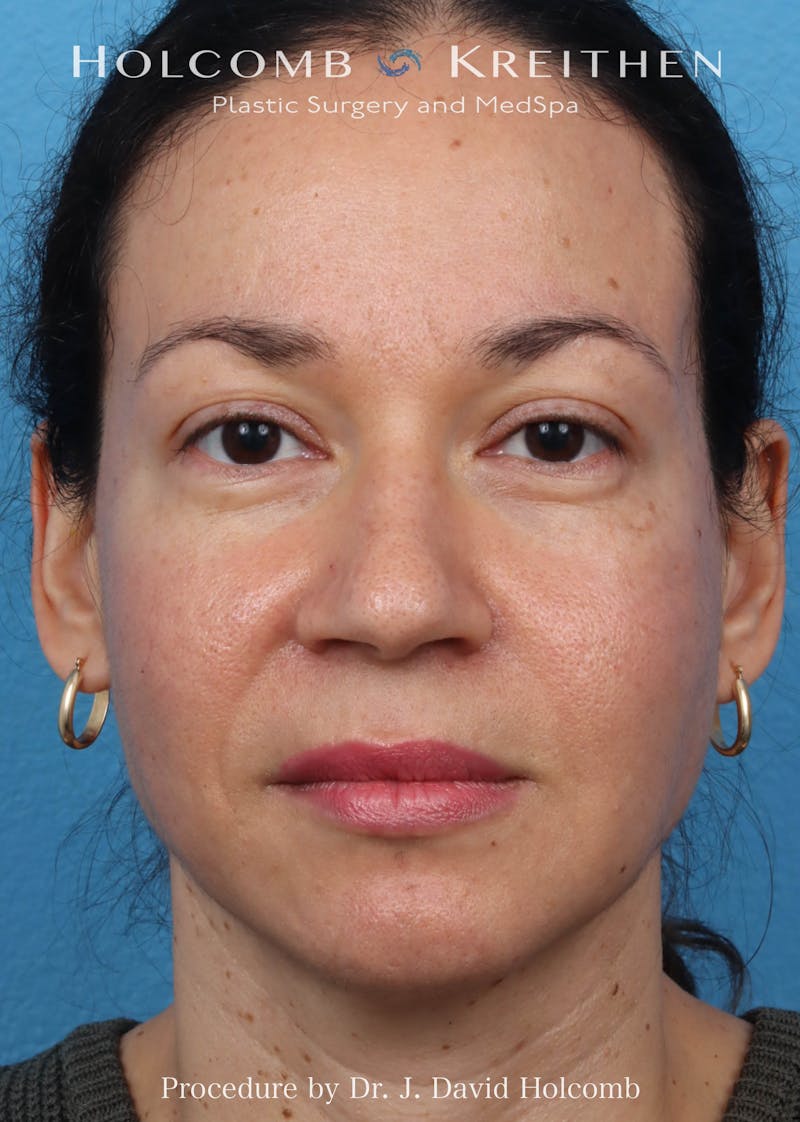 Rhinoplasty Before & After Gallery - Patient 169080 - Image 3