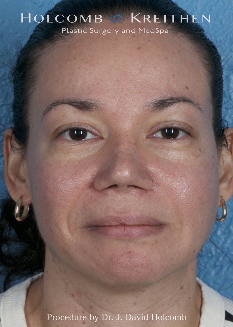 Rhinoplasty Before & After Gallery - Patient 169080 - Image 4