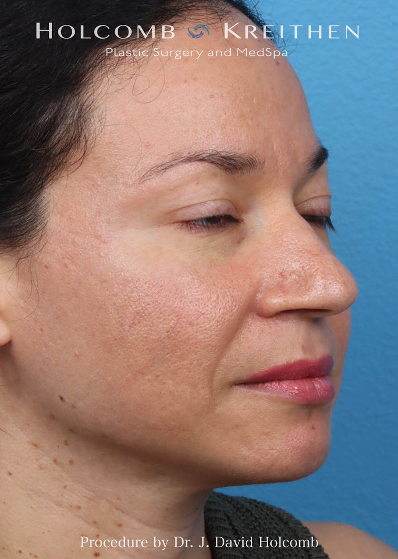 Rhinoplasty Before & After Gallery - Patient 169080 - Image 5