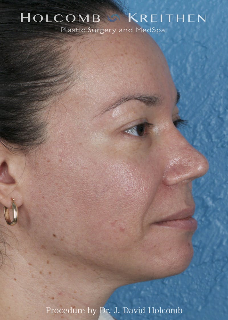 Rhinoplasty Before & After Gallery - Patient 169080 - Image 6
